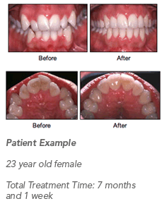 Accelerated Osteogenic Orthodontics