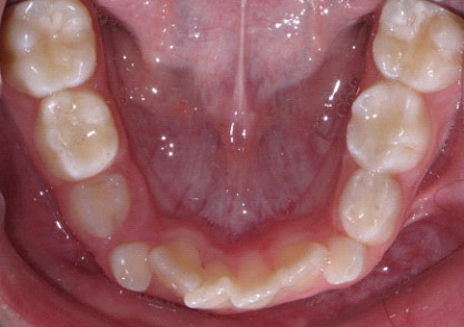 Crowding and overlapping teeth