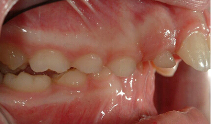 protrusive-bucked-teeth
