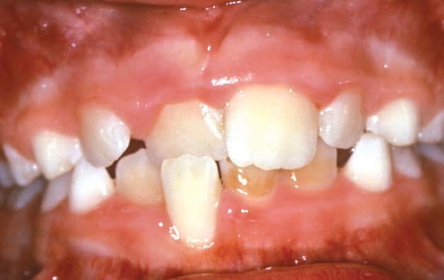 Crossbite Beam Orthodontics in Sugar Land, TX