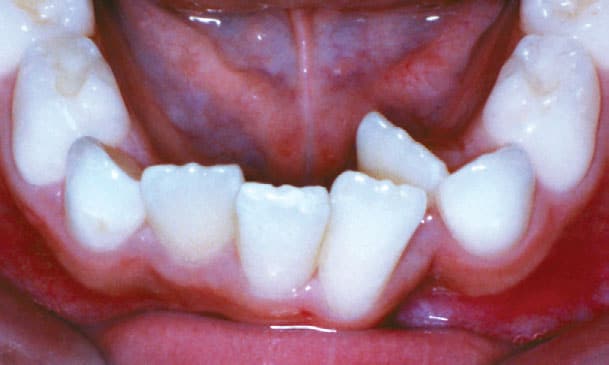 Crowding Beam Orthodontics in Sugar Land, TX