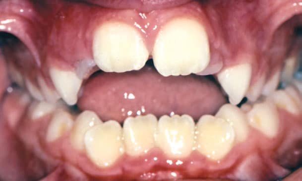 Open Bite Beam Orthodontics in Sugar Land, TX