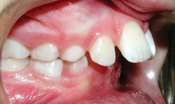 Protrusion Beam Orthodontics in Sugar Land, TX