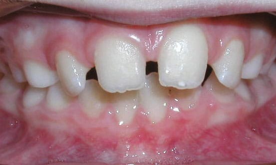 Spacing Beam Orthodontics in Sugar Land, TX
