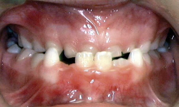Underbite Beam Orthodontics in Sugar Land, TX