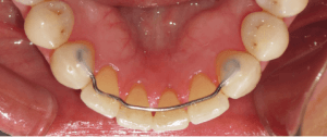 fixed bonded retainer lower teeth